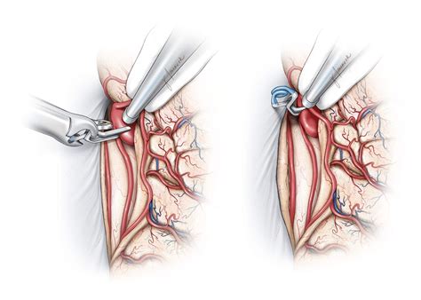 Pericallosal Artery Aneurysm | The Neurosurgical Atlas