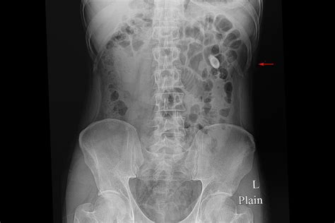 Are Kidney Stones and Prostate Related | Advanced Urology