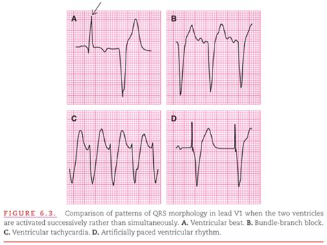 Intraventricular Conduction Delay Ekg