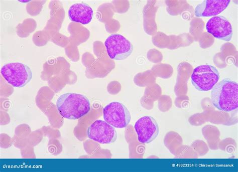 Lymphoblast stock photo. Image of leukocyte, microbiology - 49323354