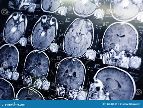 MRI Scan of a Patient with a Tumor in the Brain Stem. Stock Image - Image of medicine, scan ...