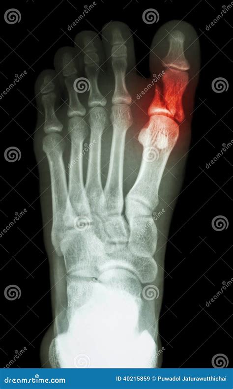 Fracture Proximal Phalange at First Toe Stock Image - Image of exam ...