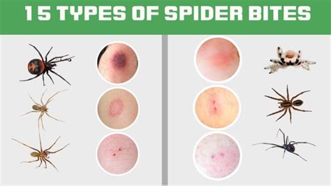 15 Types Of Spider Bites: Identification Chart with Picture