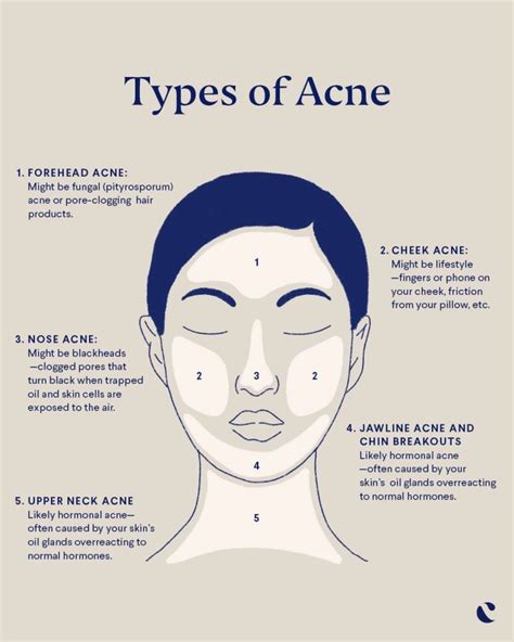 What to know about acne face mapping | Curology | Forehead acne, Pimples on face, Skin care routine