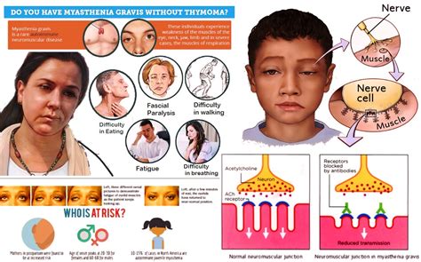 Myasthenia Gravis Disease Symptoms