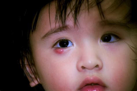 Eye Infection Types, Symptoms & Treatments in Babies - New Kids Center