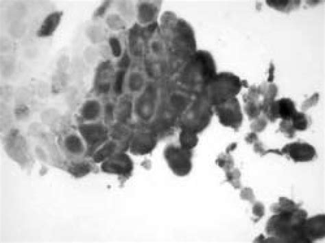 Bronchial brush cytology specimen showing a multinucleated giant ...