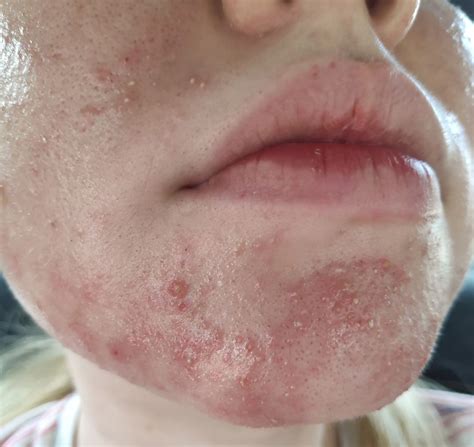 From Fungal Acne/Folliculitis to Clear Skin (with Pictures) | Skin Careless