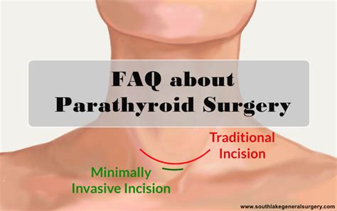 FAQs about Parathyroid Surgery - Southlake General Surgery