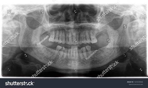 X Ray Human Mouth Teeth Bones Stock Photo 1323249506 | Shutterstock