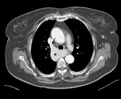 Azygos vein aneurysm - A rare entity | Eurorad