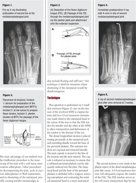 Figure 1 from Modification of lesser metatarsophalangeal joint arthroplasty using flexor ...