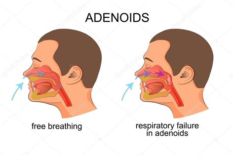 Adenoiditis, respiratory failure — Stock Vector © Artemida-psy #111355976