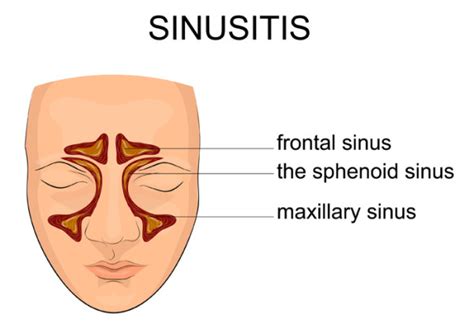 Sinusitis Symptoms and Sinusitis: How to Find Relief - University Health News