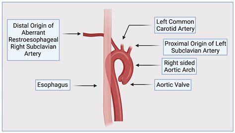 Right Aortic Arch With Aberrant Left Subclavian