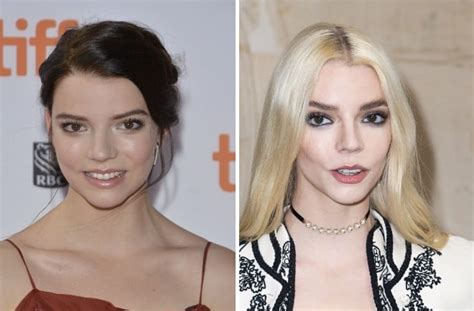 Anya Taylor-Joy Before and After Plastic Surgery