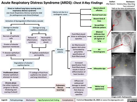 Acute Respiratory Distress Syndrome (ARDS): Chest X-Ray Findings | Calgary Guide