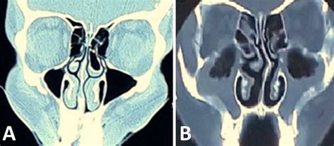 Coronal CT scan of the NPS (A) large left Concha bullosa and the... | Download Scientific Diagram