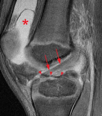 Tibial Intercondylar Eminence Fractures | Radsource