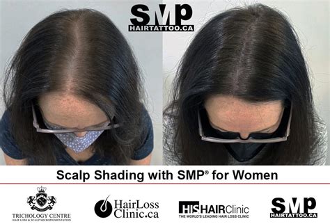 SMP treatment for hair loss Toronto | The Original SMP® Scalp Micropigmentation Hair Tattoo Clinic