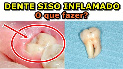 Imagens De Dente Inflamado : Leia o texto e tire suas dúvidas.