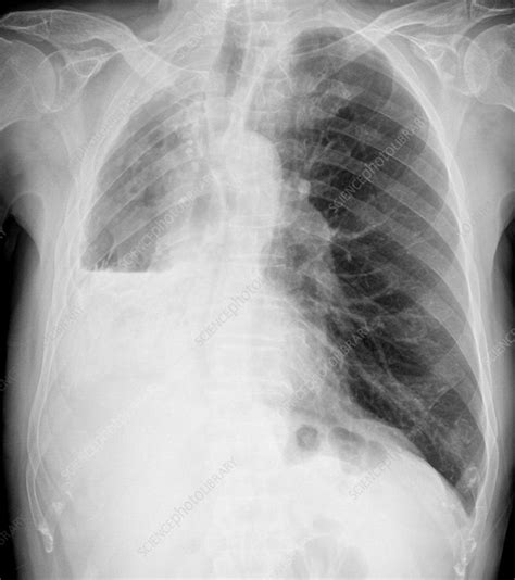 Pleurisy, X-ray - Stock Image C011/9695 - Science Photo Library