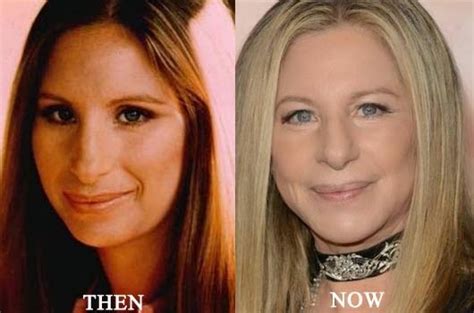 Barbra Streisand Plastic Surgery Before and After Photos - CelebLens.Com