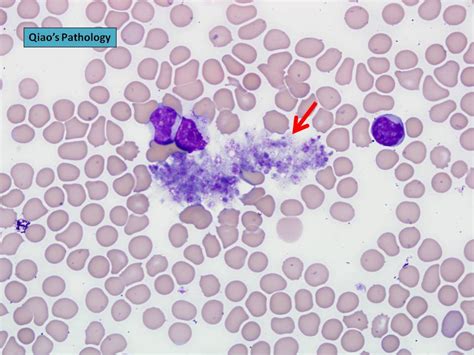 EDTA-Induced Pseudothrombocytopenia seen on blood smear | Medical ...