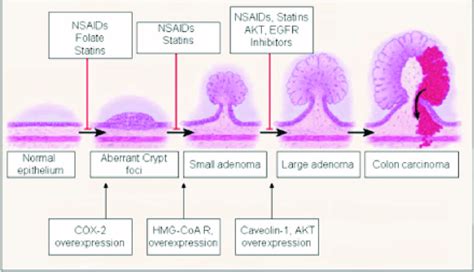 Colorectal Cancer Progression