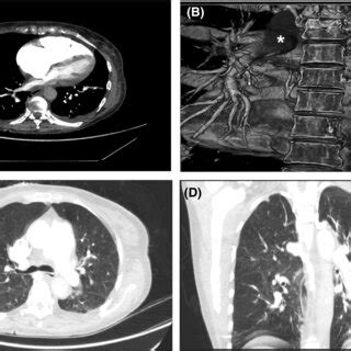 Patient's computed tomography pulmonary angiogram with... | Download Scientific Diagram