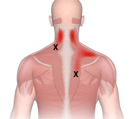 Trigger Point Injections Chicago | Metropolitan Institute of Pain