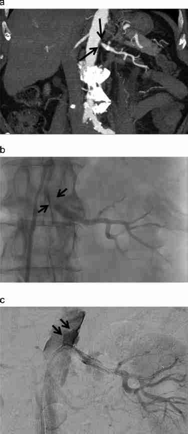 Abdominal CT angiography and renal artery angiography. A. Abdominal CT ...