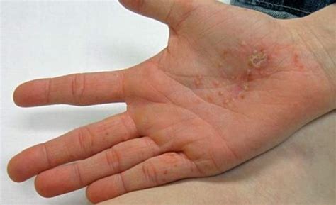 dyshidrotic-eczema-pictures