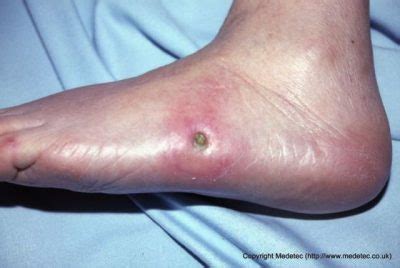 At-Risk Patient: Diabetic Foot Ulcers - Wound Care Weekly