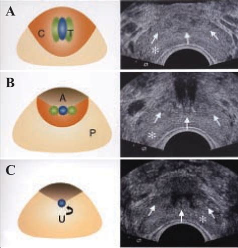 Transrectal ultrasound findings of a normal prostate in a 26-year-old... | Download Scientific ...