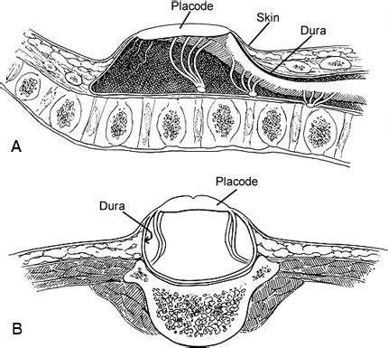 Myelomeningocele Repair - Barrow Neurological Institute