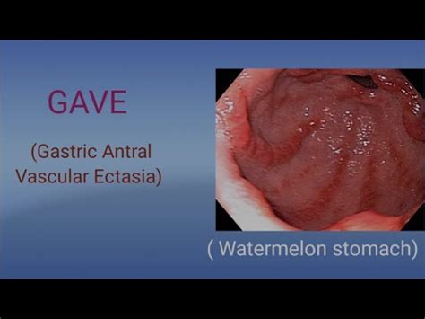 Gastric Antral Vascular Ectasia (GAVE) // Watermelon Stomach #medicasplash - YouTube