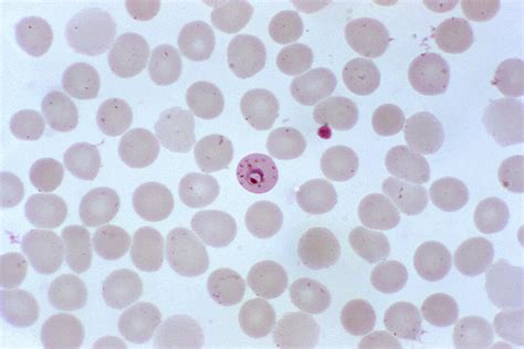 Free picture: photomicrograph, shows, plasmodium falciparum, parasite, ring, stage, maurers, dots