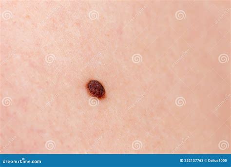 Precancerous Mole - Birthmark is Potentially Cancerous Melanoma Stock Image - Image of cancer ...