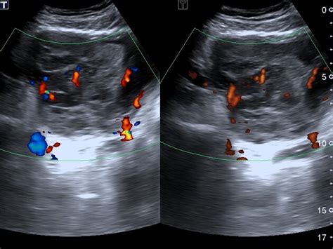 Prostate Anatomy Ultrasound