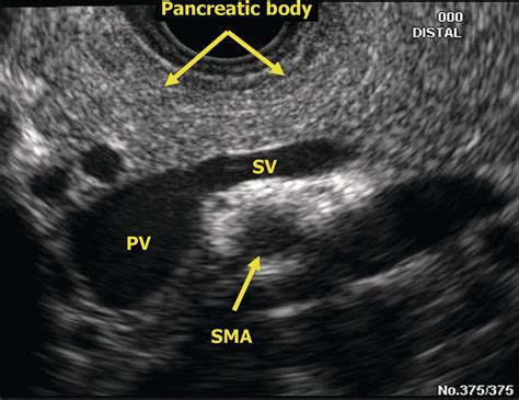 EUS of the Normal Pancreas | Radiology Key