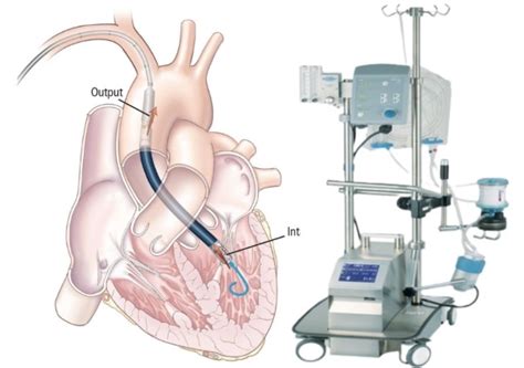 Clinical Spotlight: The Latest Heart Technology is a Lifesaver | Torrance Memorial Foundation