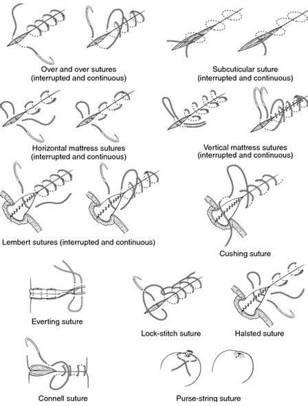 Wound stitches | Stitches medical, Surgical suture, Medical knowledge