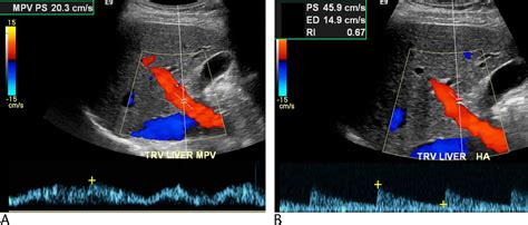 Duplex Doppler Ultrasound of the Hepatic Artery: A Window to ...