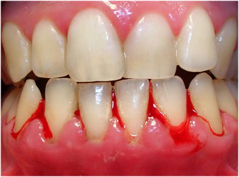 Gingivitis - Symptoms, Causes, Treatment, Cure, Prevention | Diseases Pictures