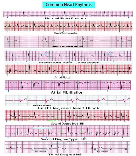 See this Instagram photo by @medical.doctors • 778 likes Ekg Rhythms ...