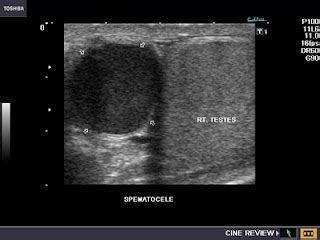 cochinblogs: Ultrasound- Spermatoceles versus epididymal cysts: