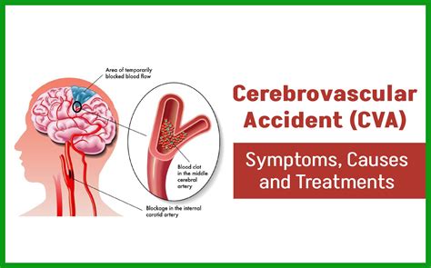 Cerebrovascular Accident (CVA): Causes, Symptoms & Treatment