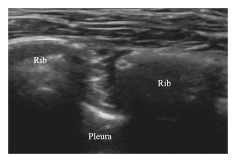 Ultrasound image of intercostal nerve blocks. (a) Placement of the ...