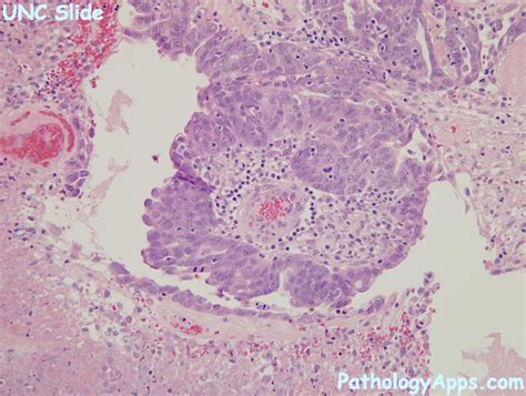 endometrial serous carcinoma pathology